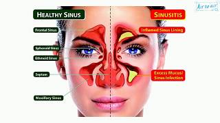 catarrh English  Medical terminology for medical students [upl. by Ridinger]