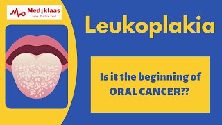 Leukoplakia l Precancerous lesions l Oral pathology l Mediklaas [upl. by Constantina]