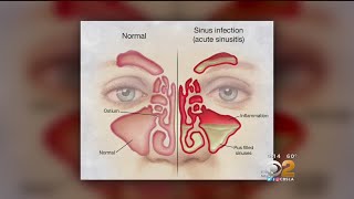 Doctor Tried And True Methods For Sinus Relief Are Still Best [upl. by Nnairol]