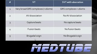 VT vs SVT with aberrancy Made Easy [upl. by Anivid]