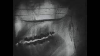 Cine fluorography of cleft palate speech  The Johns Hopkins Medical Institutions circa 1956 [upl. by Eibur830]