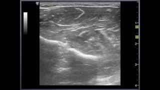 Medial Nerve  wrist to elbow Sonoanatomy  QMH AED Ultrasound Casebook 2013 Video 11 [upl. by Locklin474]