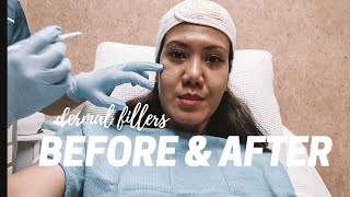 my first time dermal fillers under eyes and cheeks Restylane Philippines BEFORE amp AFTER [upl. by Teodor]