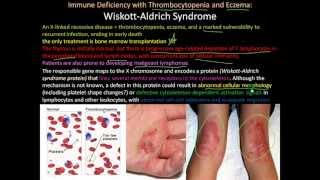 107P Severe Combined Immunodeficiency Wiskott Aldrich Syndrome [upl. by Anidene]