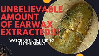 UNBELIEVABLE Amount Of Earwax Extracted From This Ear Watch Until The End [upl. by Annissa692]