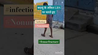 बदायूं के अंकित का हुआ LRS से infected femur nonunion का सफल इलाज boneinfection ilizarovsurgery [upl. by Ahsilrae]