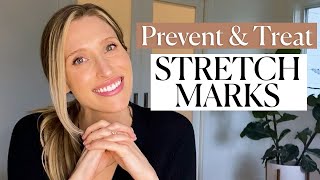 5 Essential Tips to Prevent Stretch Marks During Pregnancy  Maintain Smooth Healthy Skin [upl. by Winna]