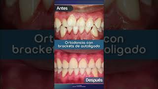 Ortodoncia con brackets de autoligado ¿listo para alinear tu sonrisa [upl. by Ylro]