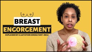 BREAST ENGORGEMENT Postpartum  Causes of Breast Engorgement Symptoms Effective Treatments [upl. by Aral]