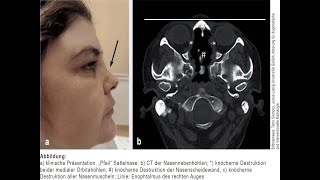 Orbitabodenbeteiligung bei Granulomatose mit Polyangiitis [upl. by Bierman469]