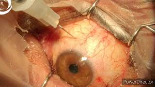 800 how to inject intravitreal to avoid endophthalmitis [upl. by Nosnaj]