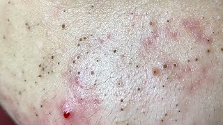 Acne Treatment Huong Da Nang The video has been lost for a long time Remove Blackheads [upl. by Henn]