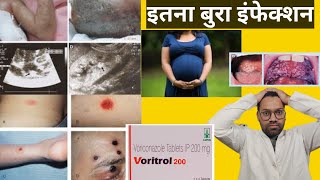 Voriconazole 200mg tablet  best antifungal medicine  कुछ खतरनाक इंफेक्शन के लिए [upl. by Vernor334]