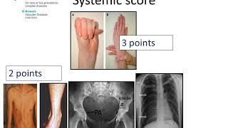 Marfan Syndrome  Diagnosis by Prof Julie De Backer [upl. by Morgenthaler]