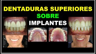 PRÓTESIS DENTAL TOTAL SUPERIOR DENTADURAS SOBRE IMPLANTES [upl. by Ardnahc]