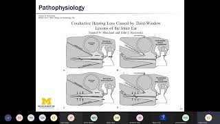 Superior Semicircular Canal Dehiscence  Dr Emily Stucken MD  University of Michigan [upl. by Bartlet]