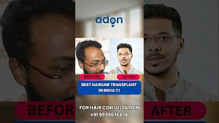 Best HairLine Transplant in Indiaadonhaircare hairregrowth hairtransplant [upl. by Refiffej660]