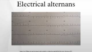 Electrical alternans [upl. by Raymond405]