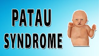 Patau Syndrome [upl. by Enileuqcaj]