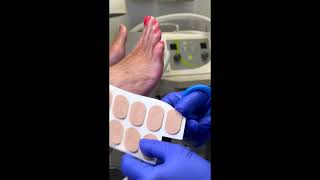 5th toe corn pad and debridement  short debridement toecornpad [upl. by Walke]