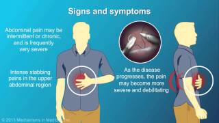 Chronic Pancreatitis [upl. by Eoin]