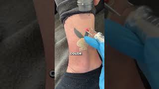 Tattoo Removal hwclinicbrugge [upl. by Willumsen]