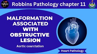 Malformations Associated With Obstructive Lesions Aortic Coarctation pathology robbins heart [upl. by Athenian643]