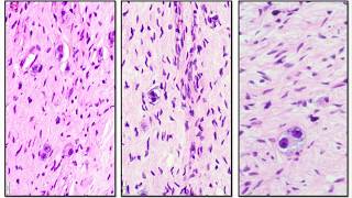 Neuroblastoma and Ganglioneuroma  Adventures in Neuropathology [upl. by Farand]