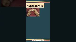 Hyperdontia [upl. by Noe]