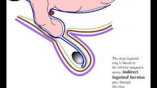 Direct and indirect inguinal hernia [upl. by Lotson607]