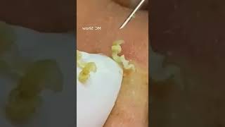 Pickel Ausdrücken Blackheads Akne amp Mitesser entfernen 🔴 7 [upl. by Mohn]