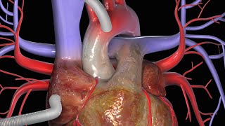 Cirurgia de Revascularização do Miocárdio CRM [upl. by Anaeerb]