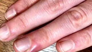 What is PARONYCHIA  Finger nail infection  Solve Paronychia with these simple Home Remedies [upl. by Eeresed646]