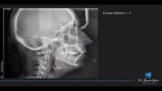 Cephalometric 2 قياسات الرأس 2 للدكتور غزوان الباشا [upl. by Fawnia]