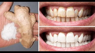 Teeth whitening at home with Garlic How to Get Rid of Yellow Teeth at Home [upl. by Nnanerak]