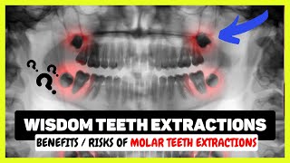 Wisdom Teeth Extraction Procedure  Removal Cost Pain Dry Socket [upl. by Vani69]