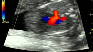 large right atrium fetal heart at 19 weeks [upl. by Akerley]