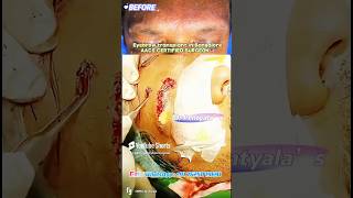 Eyebrow Hair Transplant results in Bangalore  drpentyalas eyebrowtransplant results india hair [upl. by Yllah]