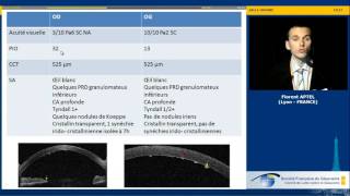 Hypertonie et uvéites  cas clinique Florent Aptel [upl. by Nylaroc846]
