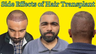 Side Effects of Hair Transplant  Precautions after Hair Transplant  Hair Transplant Results [upl. by Forta]