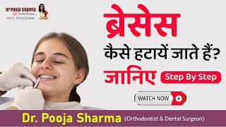 Braces Off  Know Step By Step Dental Braces Removal By In Agra UP  Dr Pooja Sharma [upl. by Horgan951]