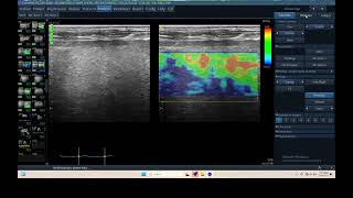 IQ 305 LIVER ULTRASOUND ECHOPAC ANALYSIS HEPATOMA ELASTOGRAPHY [upl. by Nad1]