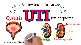 Cystitis  made simply UTI Cystitis vs pyelonephritis [upl. by Keiko342]