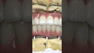 Fabulous Full Mouth Zirconia Arches lsk121shorts dentist [upl. by Toby]