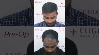 Hair Transplant Before After Your transplanted hair is permanent [upl. by Aneerol]