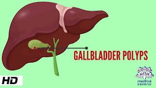 Gallbladder Polyp Causes Signs and Symptoms Diagnosis and Treatment [upl. by Behlau247]