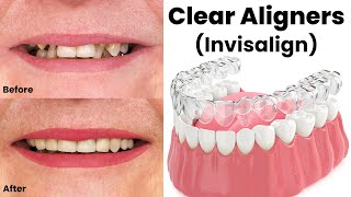 Clear Aligners Invisalign Price in Pakistan  Invisible Braces  Guide By Dr Shahzad Mirza [upl. by Licha]