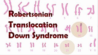 Robertsonian Translocation Down Syndrome ROB [upl. by Ahsiya632]