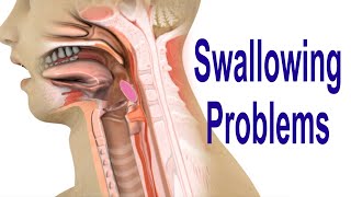 Swallowing Problems or Dysphagia Top 4 Possible Causes Including Cricopharyngeal Dysfunction CPD [upl. by Vary]