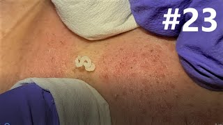 BLACKHEADS EXTRACTIONS on Happy 23 [upl. by Anett]